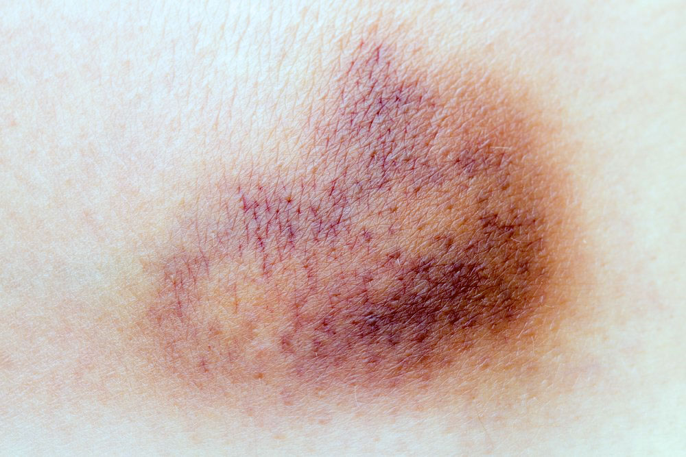 The Paris Review - The Art Of The Bruise - The Paris Review